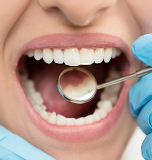 Dentist offering tooth-colored filling service in Worcester & Central, MA.