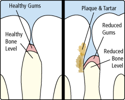 Graphical representation of inflamed gums showing signs of gum disease in Worcester & Central, MA