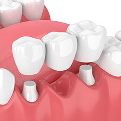 Dental Bridges in Worcester, MA