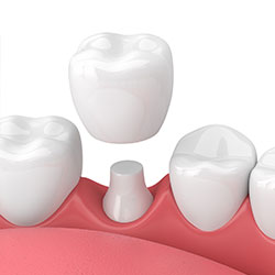 Dental Fillings in Worcester, MA