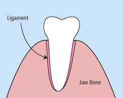 A diagram of a tooth extraction provided by Kozica Dental in Worcester, MA