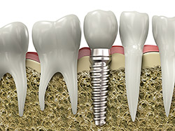 A diagram of implant restoration provided by Kozica Dental in Worcester, MA