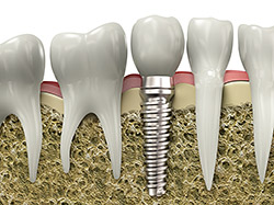 Implant Restoration in Worcester, MA