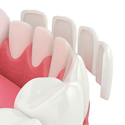 Dental Veneers in Worcester, MA