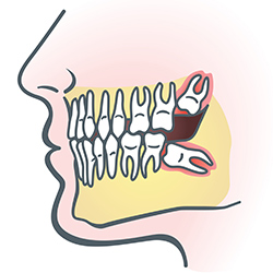 An animated photo of wisdom teeth inside a mouth created by dental office Kozica Dental in Worcester, MA